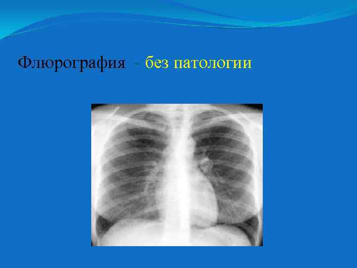 Флюрография без патологии 