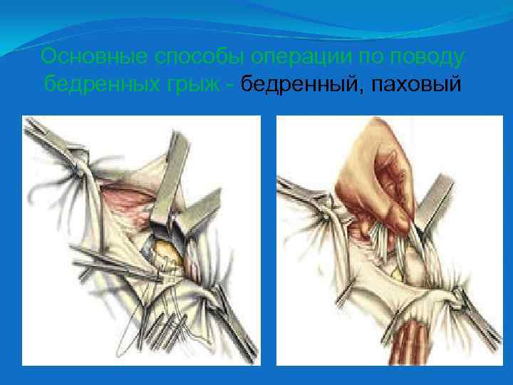 Основные способы операции по поводу бедренных грыж - бедренный, паховый 