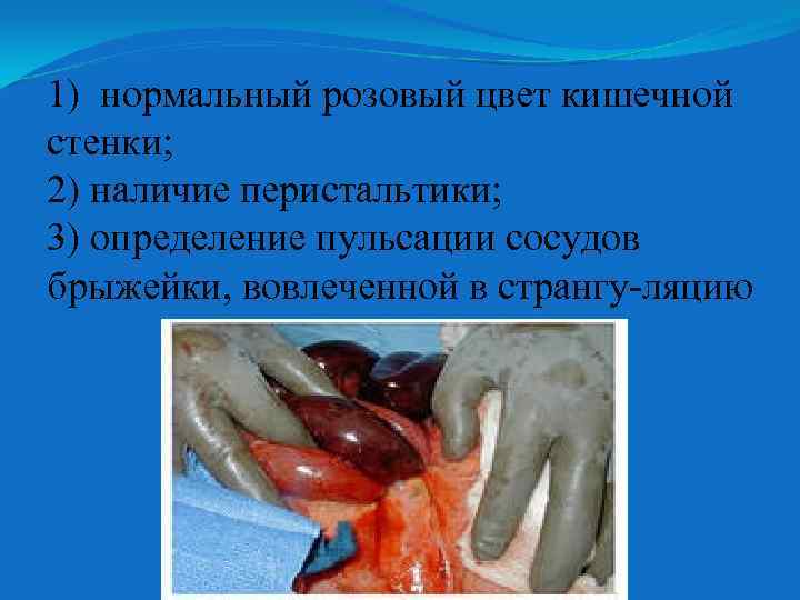 1) нормальный розовый цвет кишечной стенки; 2) наличие перистальтики; 3) определение пульсации сосудов брыжейки,