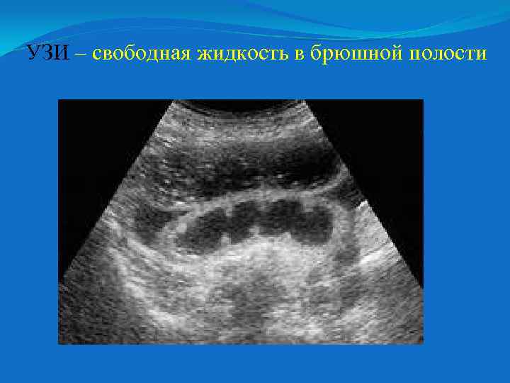 УЗИ – свободная жидкость в брюшной полости 
