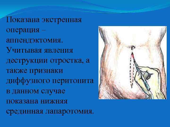 Показана экстренная операция – аппендэктомия. Учитывая явления деструкции отростка, а также признаки диффузного перитонита