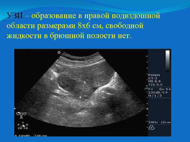 Область узи. УЗИ правой подвздошной области. Образование брюшной полости на УЗИ. Жидкость в брюшной полости на УЗИ. Жидкость в правой подвздошной области УЗИ.