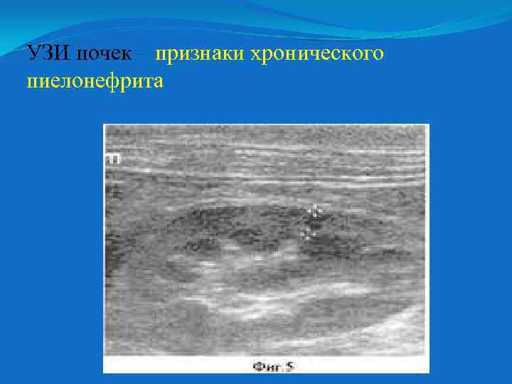 УЗИ почек – признаки хронического пиелонефрита 