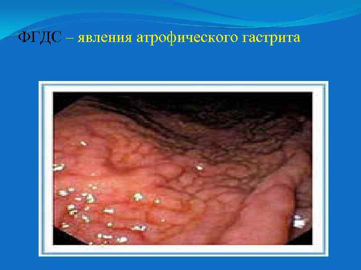 ФГДС – явления атрофического гастрита 
