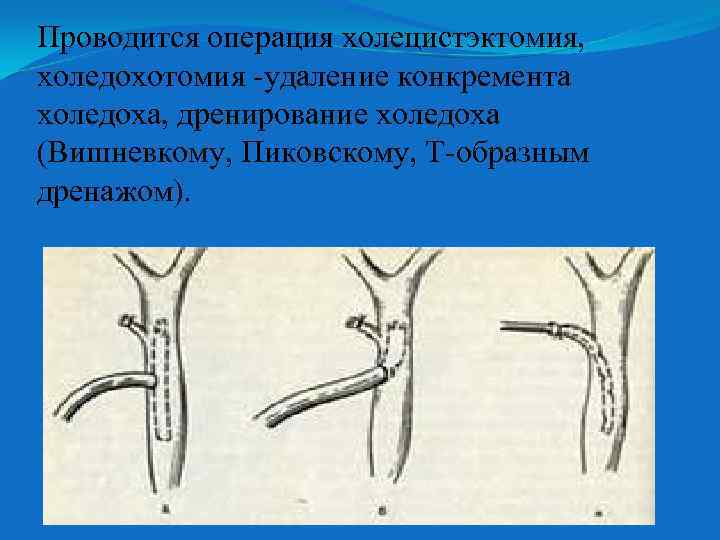 Проводится операция холецистэктомия, холедохотомия -удаление конкремента холедоха, дренирование холедоха (Вишневкому, Пиковскому, Т-образным дренажом). 