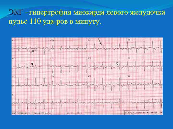 ЭКГ –гипертрофия миокарда левого желудочка пульс 110 уда ров в минуту. 