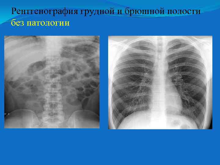 Рентгенография грудной и брюшной полости – без патологии 