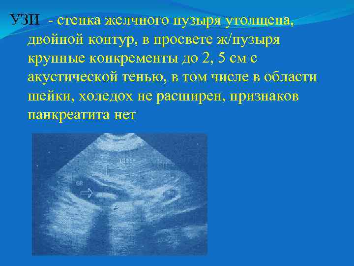 УЗИ стенка желчного пузыря утолщена, двойной контур, в просвете ж/пузыря крупные конкременты до 2,