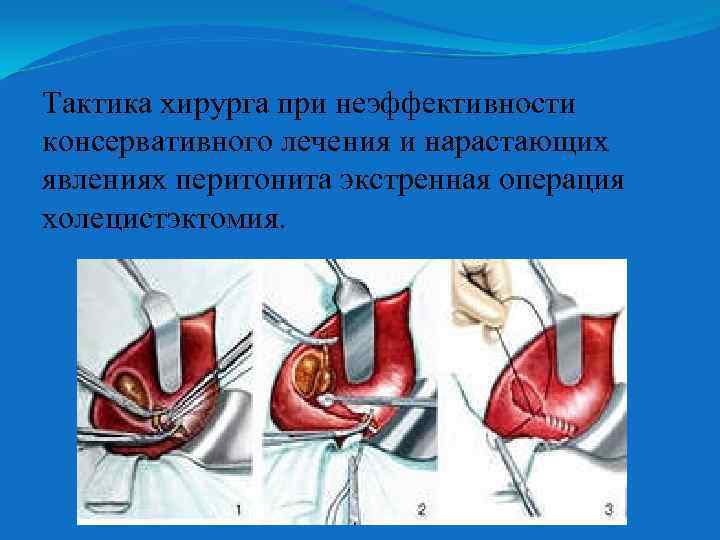 Тактика хирурга при неэффективности консервативного лечения и нарастающих явлениях перитонита экстренная операция холецистэктомия. 