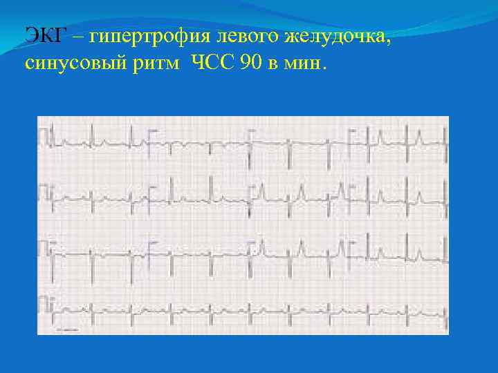 ЭКГ – гипертрофия левого желудочка, синусовый ритм ЧСС 90 в мин. 