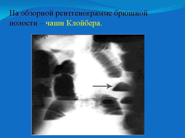 На обзорной рентгенограмме брюшной полости – чаши Клойбера. 