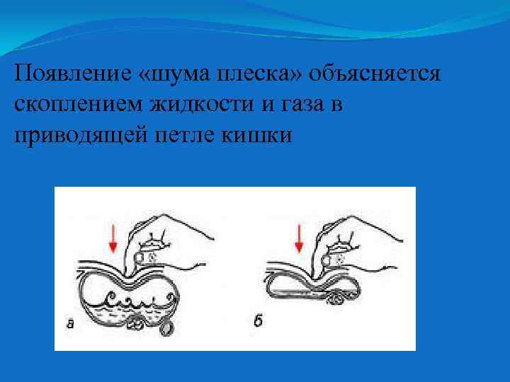 Появление «шума плеска» объясняется скоплением жидкости и газа в приводящей петле кишки 