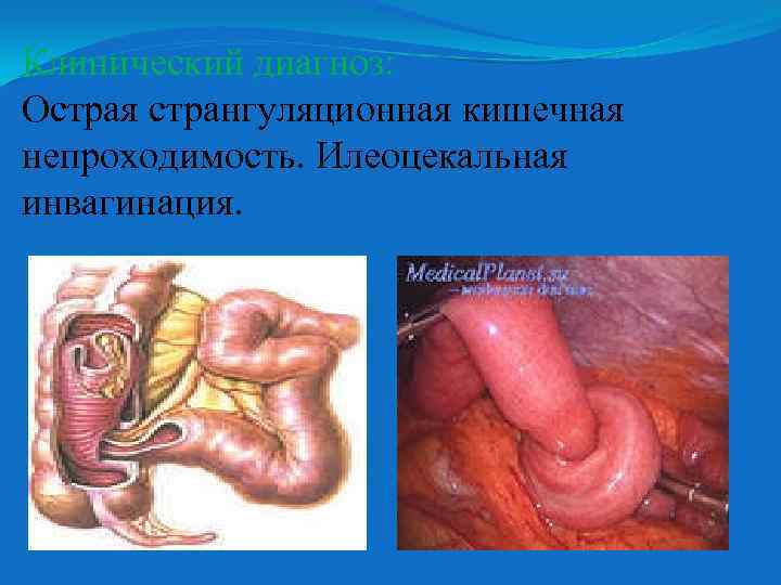 Клинический диагноз: Острая странгуляционная кишечная непроходимость. Илеоцекальная инвагинация. 