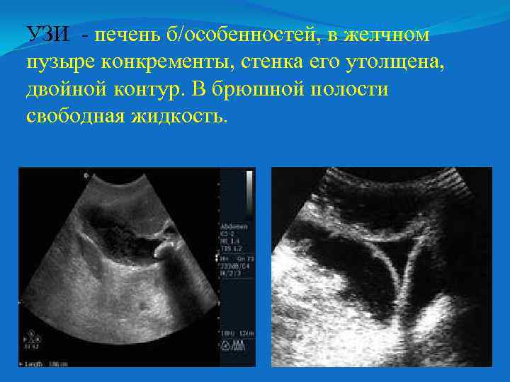 УЗИ - печень б/особенностей, в желчном пузыре конкременты, стенка его утолщена, двойной контур. В