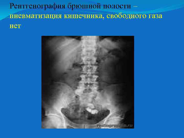 Рентгенография брюшной полости – пневматизация кишечника, свободного газа нет 