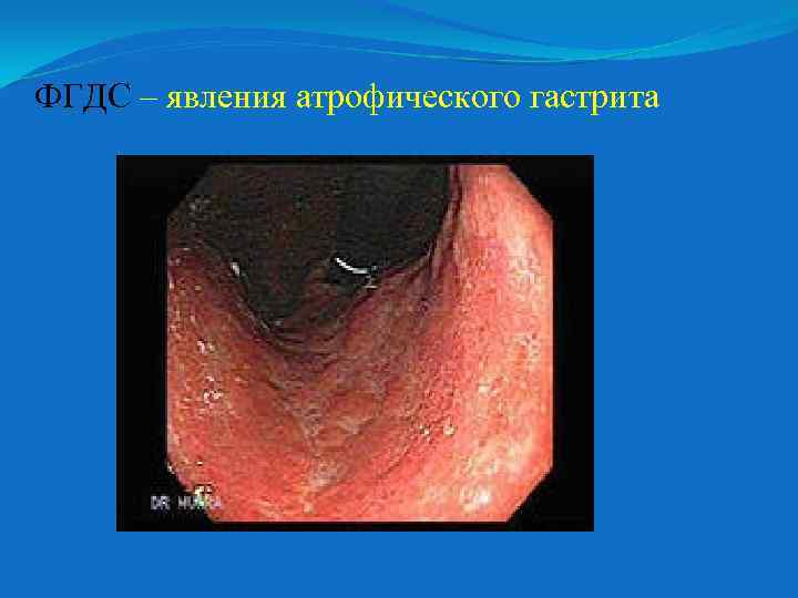 ФГДС – явления атрофического гастрита 