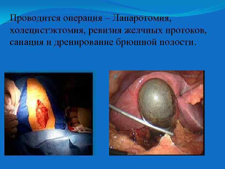 Проводится операция – Лапаротомия, холецистэктомия, ревизия желчных протоков, санация и дренирование брюшной полости. 