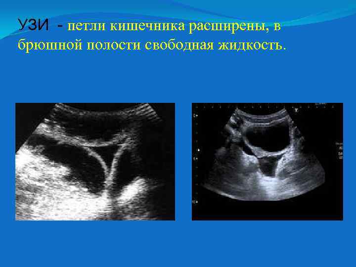УЗИ - петли кишечника расширены, в брюшной полости свободная жидкость. 