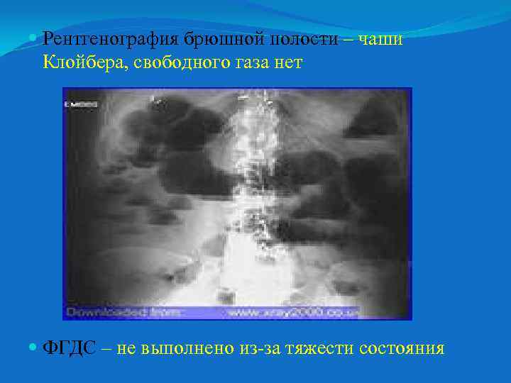  Рентгенография брюшной полости – чаши Клойбера, свободного газа нет ФГДС – не выполнено