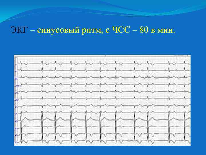 ЭКГ – синусовый ритм, с ЧСС – 80 в мин. 