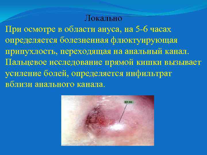 Локально При осмотре в области ануса, на 5 -6 часах определяется болезненная флюктуирующая припухлость,