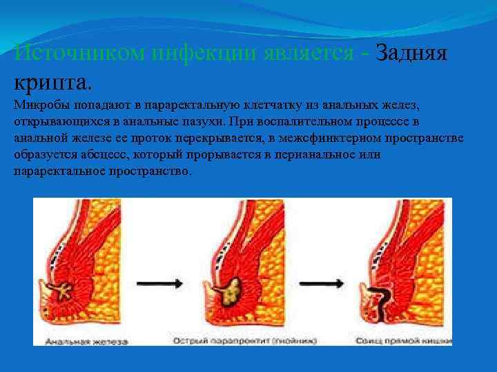 Источником инфекции является - Задняя крипта. Микробы попадают в параректальную клетчатку из анальных желез,