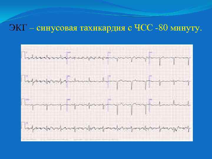 ЭКГ – синусовая тахикардия с ЧСС -80 минуту. 