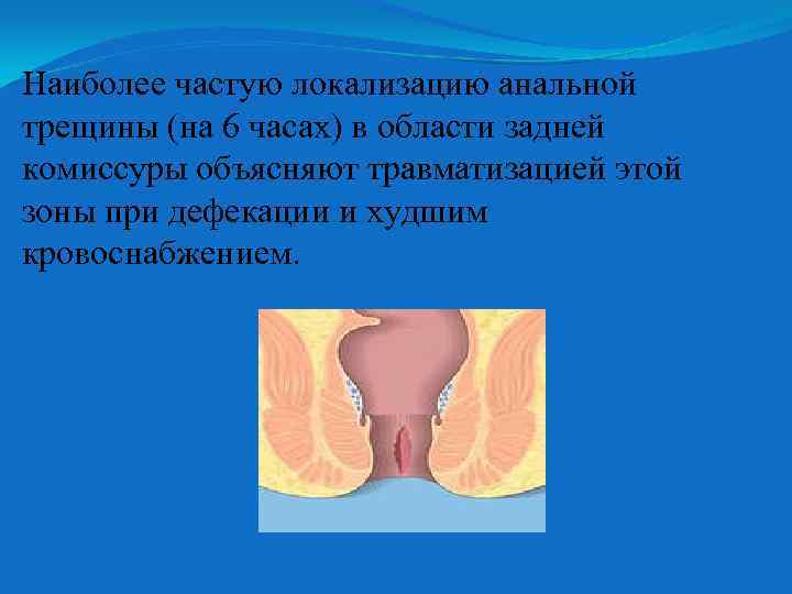 Наиболее частую локализацию анальной трещины (на 6 часах) в области задней комиссуры объясняют травматизацией