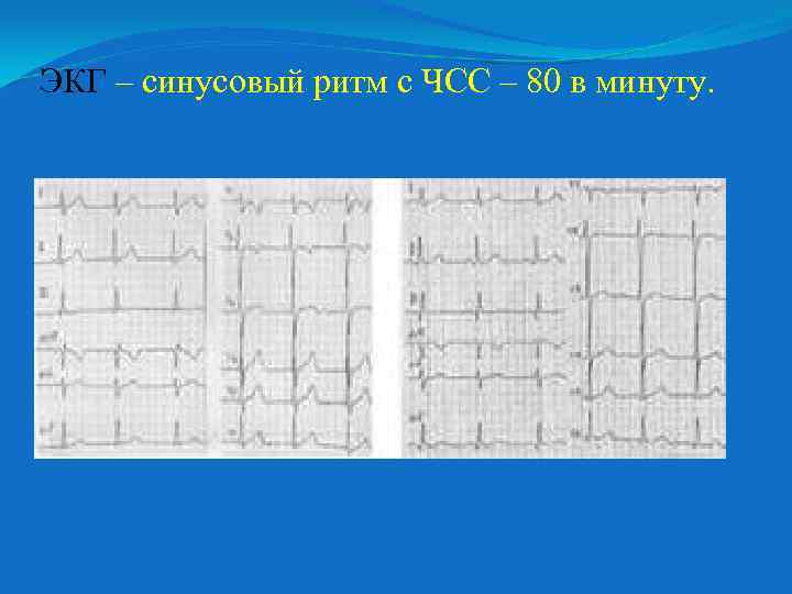 ЭКГ – синусовый ритм с ЧСС – 80 в минуту. 