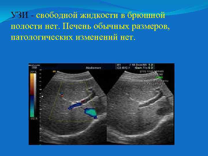 УЗИ - свободной жидкости в брюшной полости нет. Печень обычных размеров, патологических изменений нет.