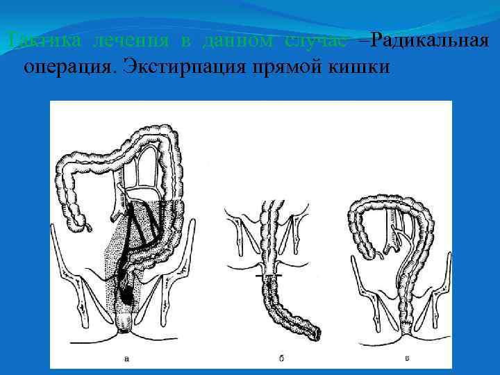 Тактика лечения в данном случае –Радикальная операция. Экстирпация прямой кишки 