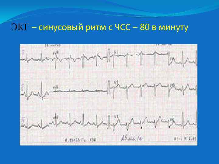 ЭКГ – синусовый ритм с ЧСС – 80 в минуту 