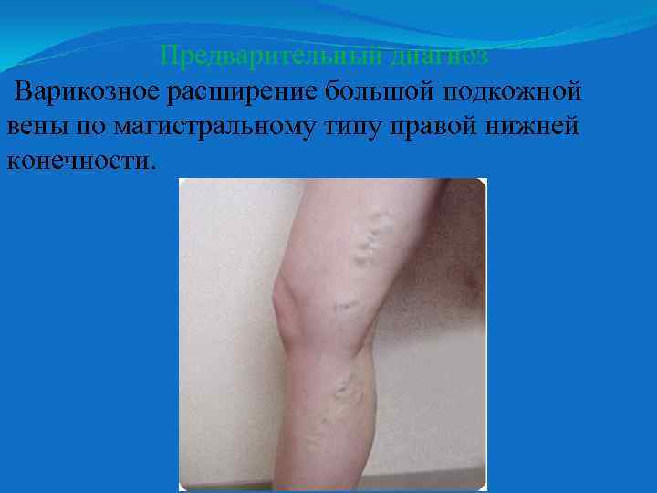 Предварительный диагноз Варикозное расширение большой подкожной вены по магистральному типу правой нижней конечности. 