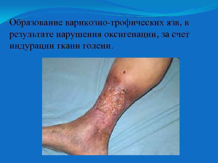 Образование варикозно-трофических язв, в результате нарушения оксигенации, за счет индурации ткани голени. 