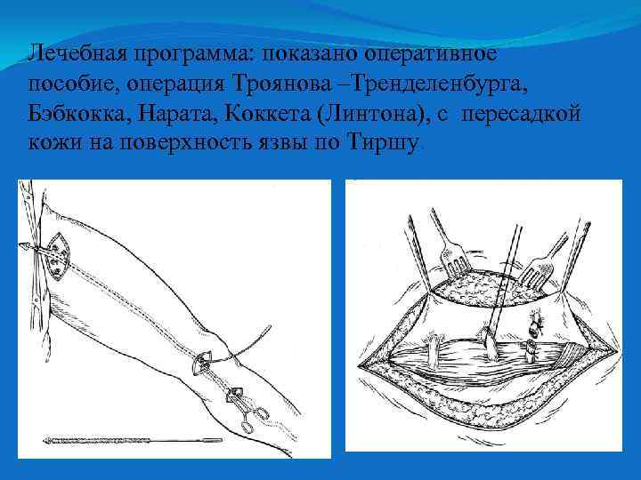 Лечебная программа показано оперативное пособие, операция Троянова –Тренделенбурга, Бэбкокка, Нарата, Коккета (Линтона), с пересадкой