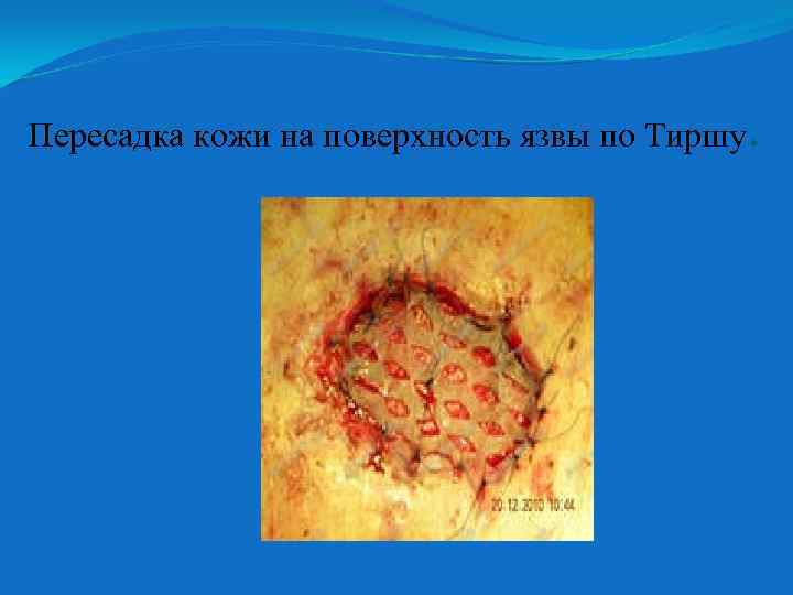 Пересадка кожи на поверхность язвы по Тиршу. 