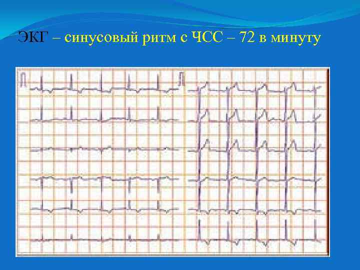 ЭКГ – синусовый ритм с ЧСС – 72 в минуту 
