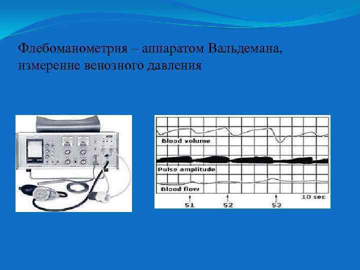 Флебоманометрия – аппаратом Вальдемана, измерение венозного давления 