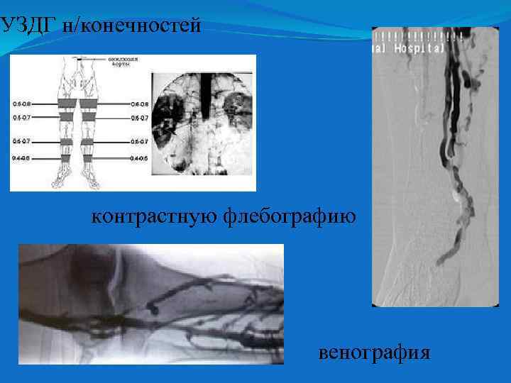 УЗДГ н/конечностей контрастную флебографию венография 