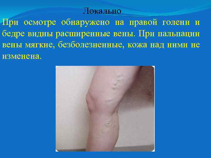 Локально При осмотре обнаружено на правой голени и бедре видны расширенные вены. При пальпации