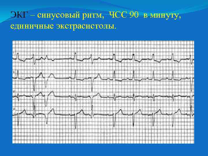 ЭКГ – синусовый ритм, ЧСС 90 в минуту, единичные экстрасистолы. 