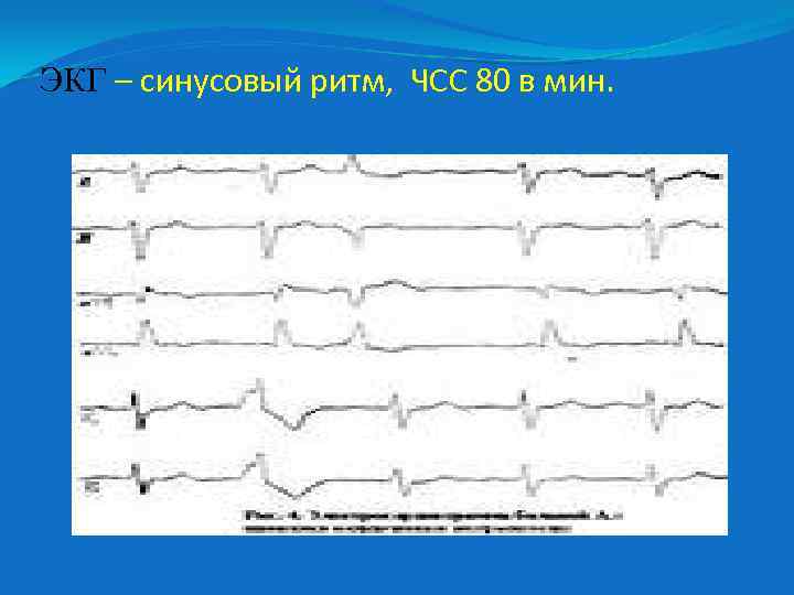 ЭКГ – синусовый ритм, ЧСС 80 в мин. 