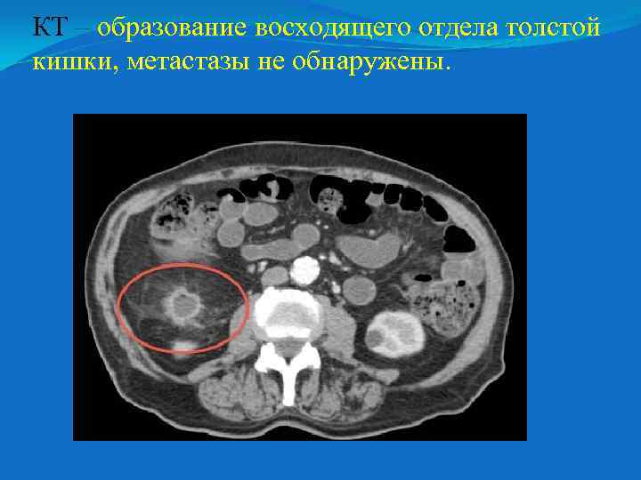 КТ – образование восходящего отдела толстой кишки, метастазы не обнаружены. 