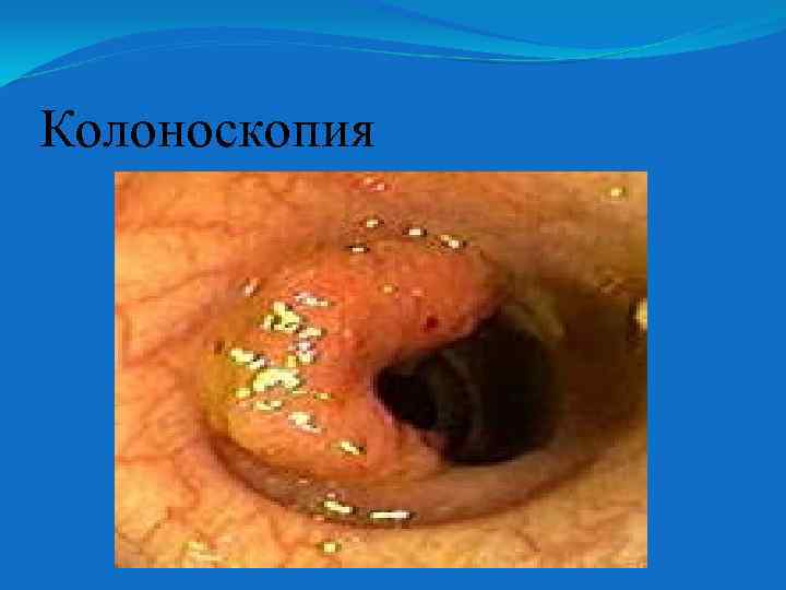 Колоноскопия 