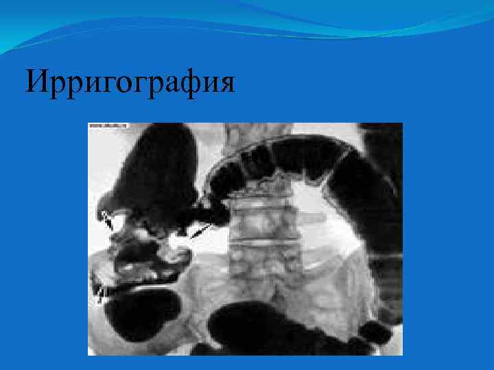 Ирригография 