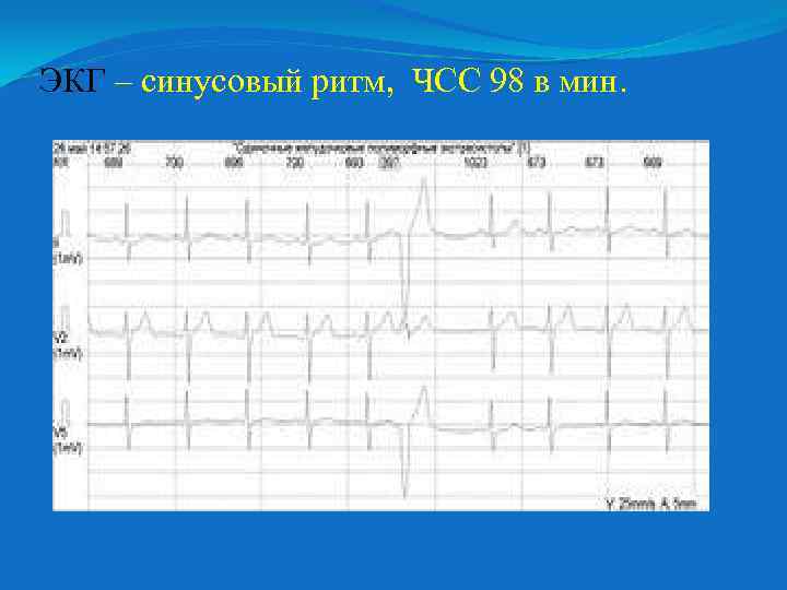 ЭКГ – синусовый ритм, ЧСС 98 в мин. 