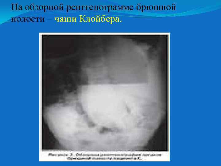 На обзорной рентгенограмме брюшной полости – чаши Клойбера. 