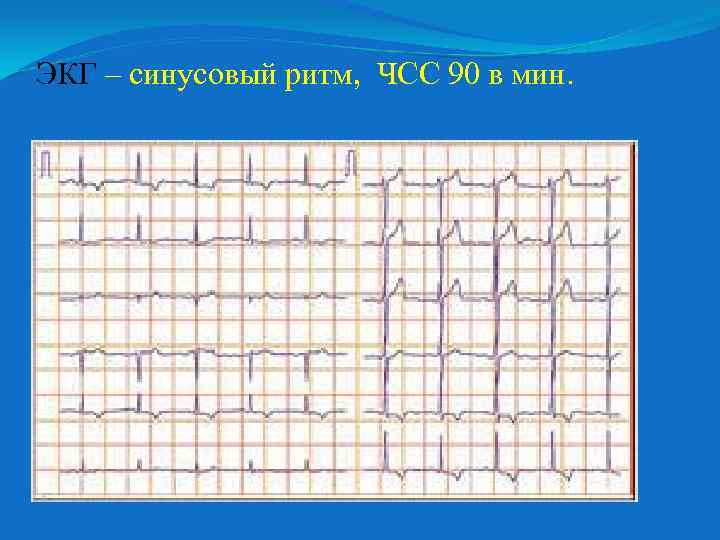 ЭКГ – синусовый ритм, ЧСС 90 в мин. 