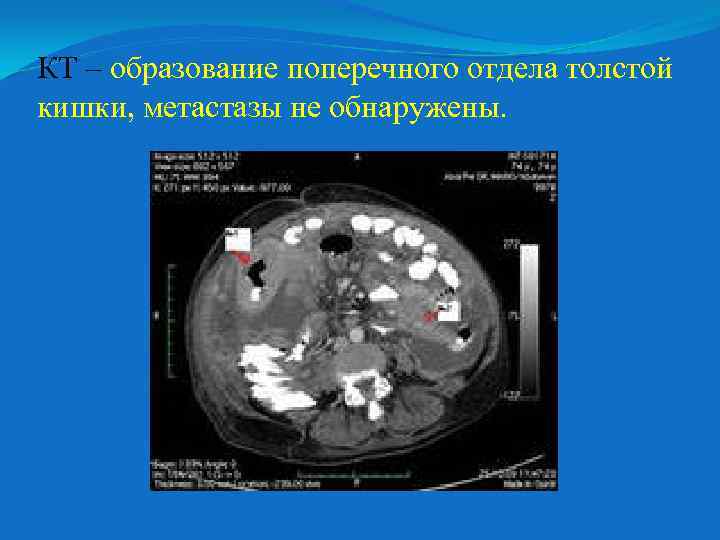 КТ – образование поперечного отдела толстой кишки, метастазы не обнаружены. 