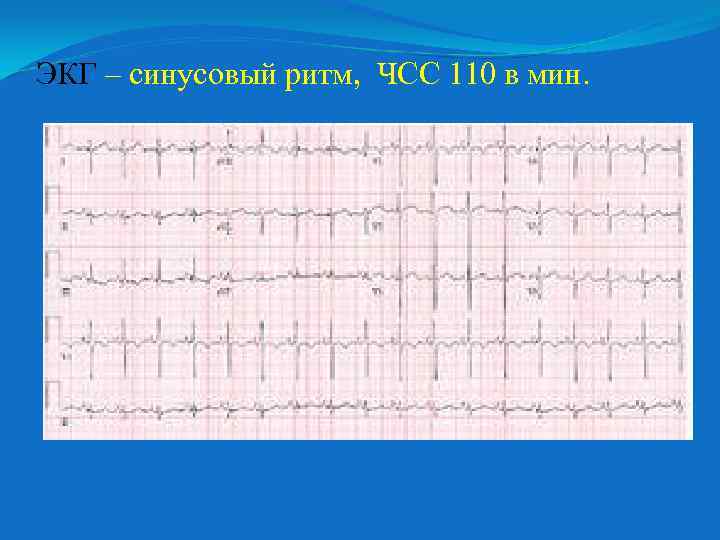 ЭКГ – синусовый ритм, ЧСС 110 в мин. 